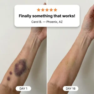 OVELISY® Bruise Repair & Skin-Strengthening Cream
